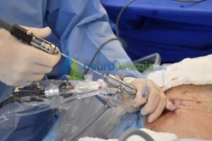 Hérnia discal tratamento cirurgico